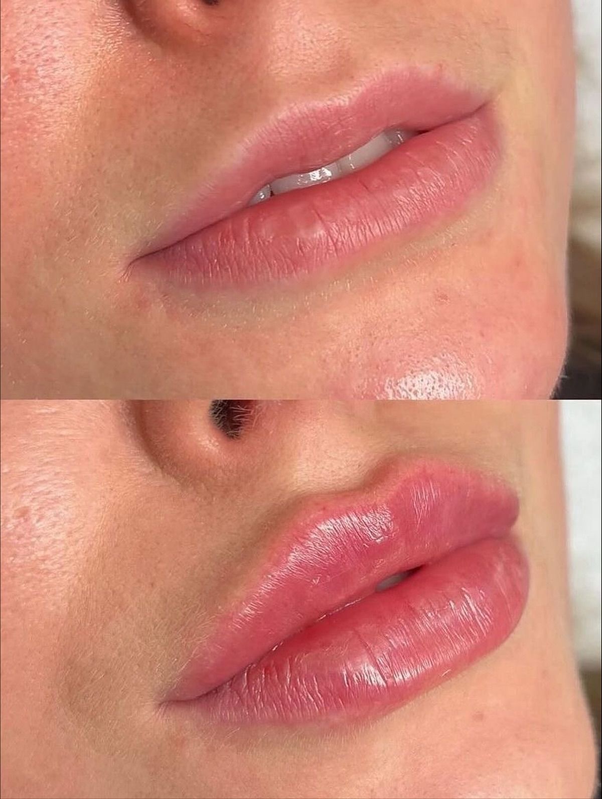 Augmentare buze acid hialuronic înainte după – Juvena