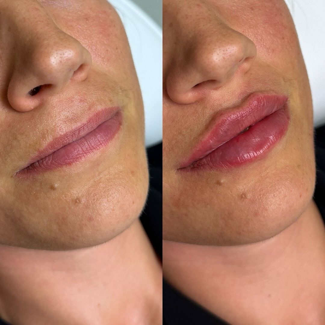 Mărire buze acid hialuronic rezultat – Juvena