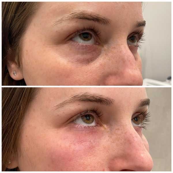 Tratament cearcăne acid hialuronic – Juvena