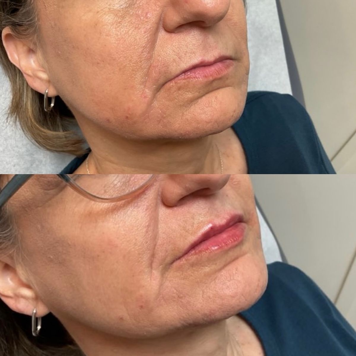 Remodelare contur facial acid hialuronic – Juvena