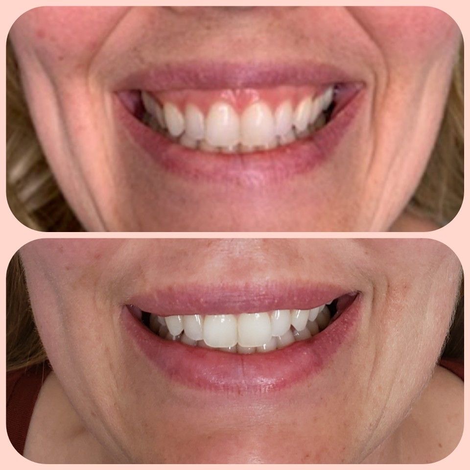 Gummy smile înainte după – toxină botulinică Juvena