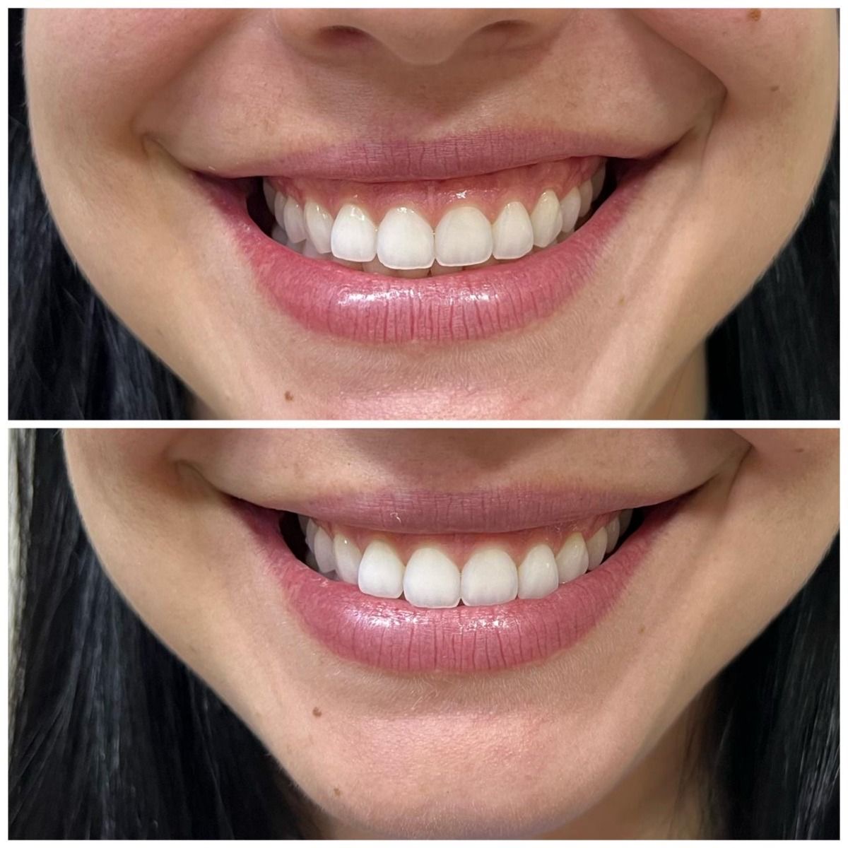 Gummy smile rezultat toxină botulinică – Juvena