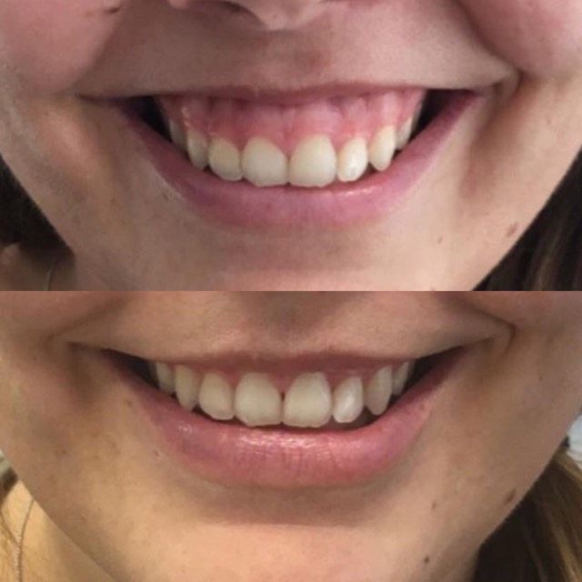 Gummy smile corectat toxină botulinică – Juvena