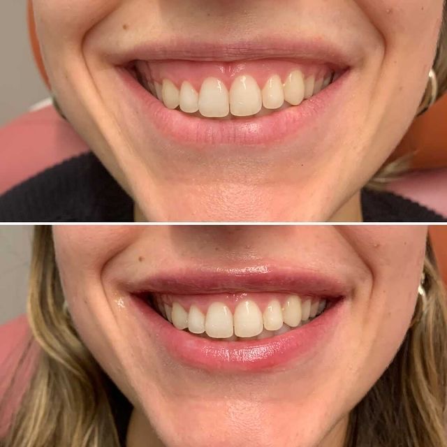 Tratament gummy smile înainte după – Juvena Timișoara