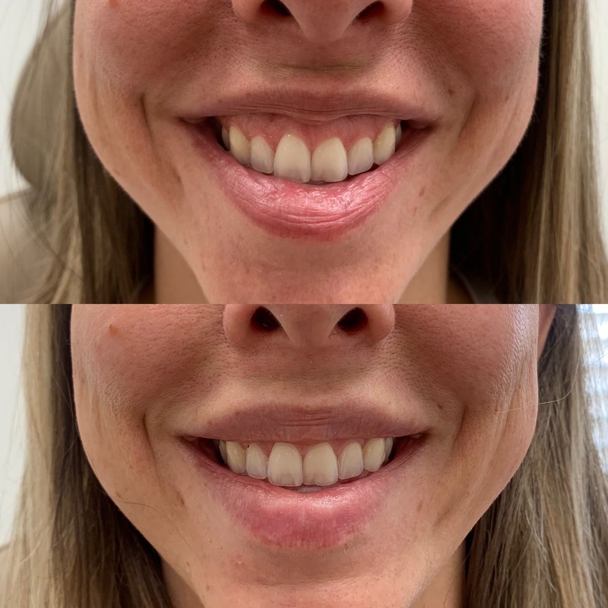 Gummy smile corectat toxină botulinică – Juvena Timișoara