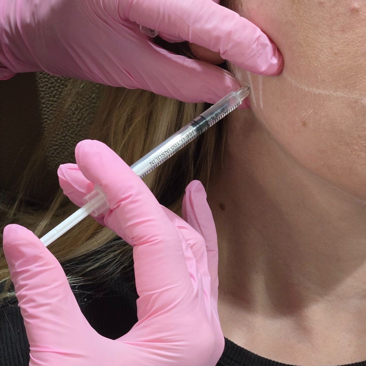 Procedură maseter face slimming – Juvena