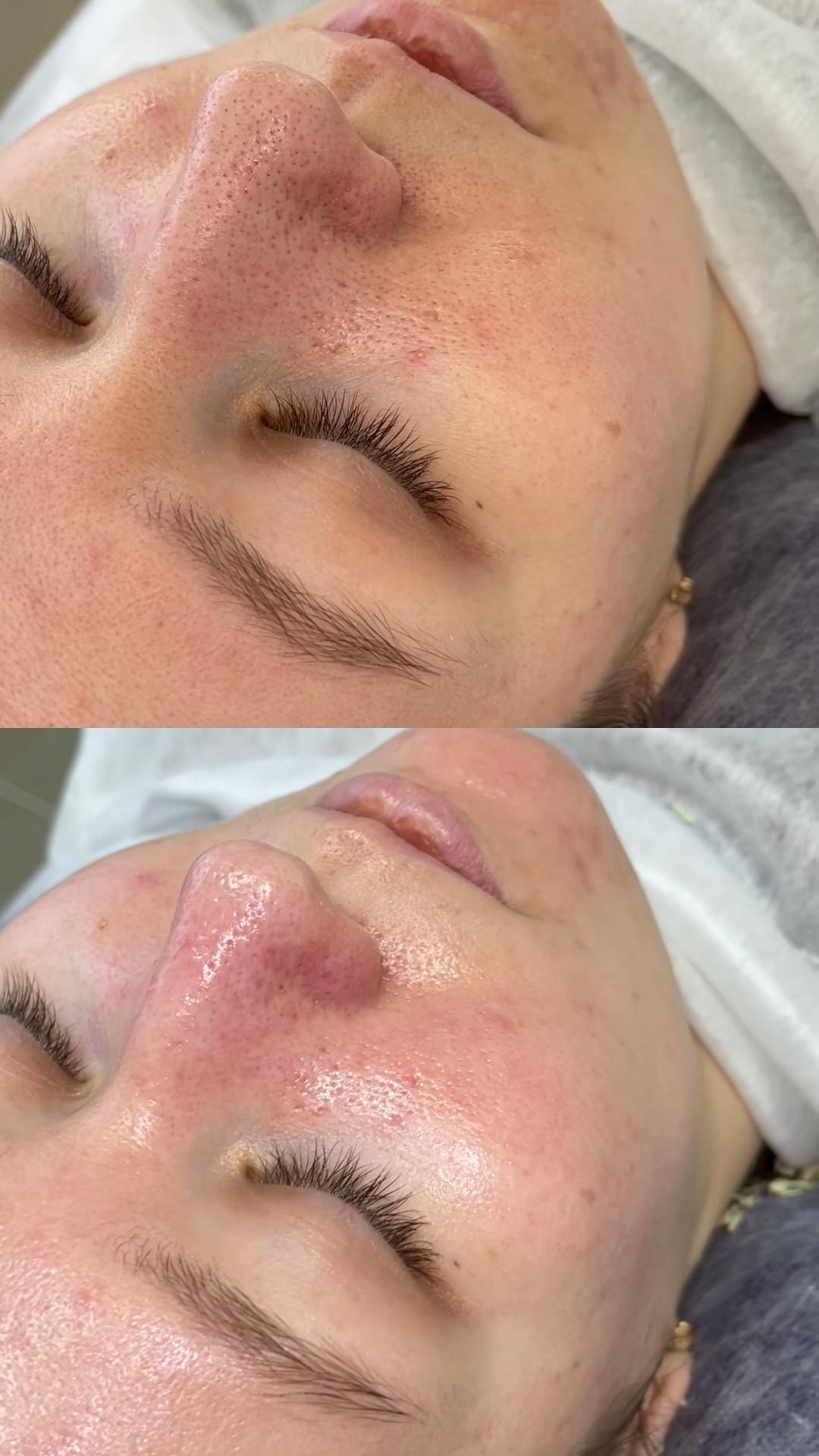 Procedură peeling chimic – Juvena