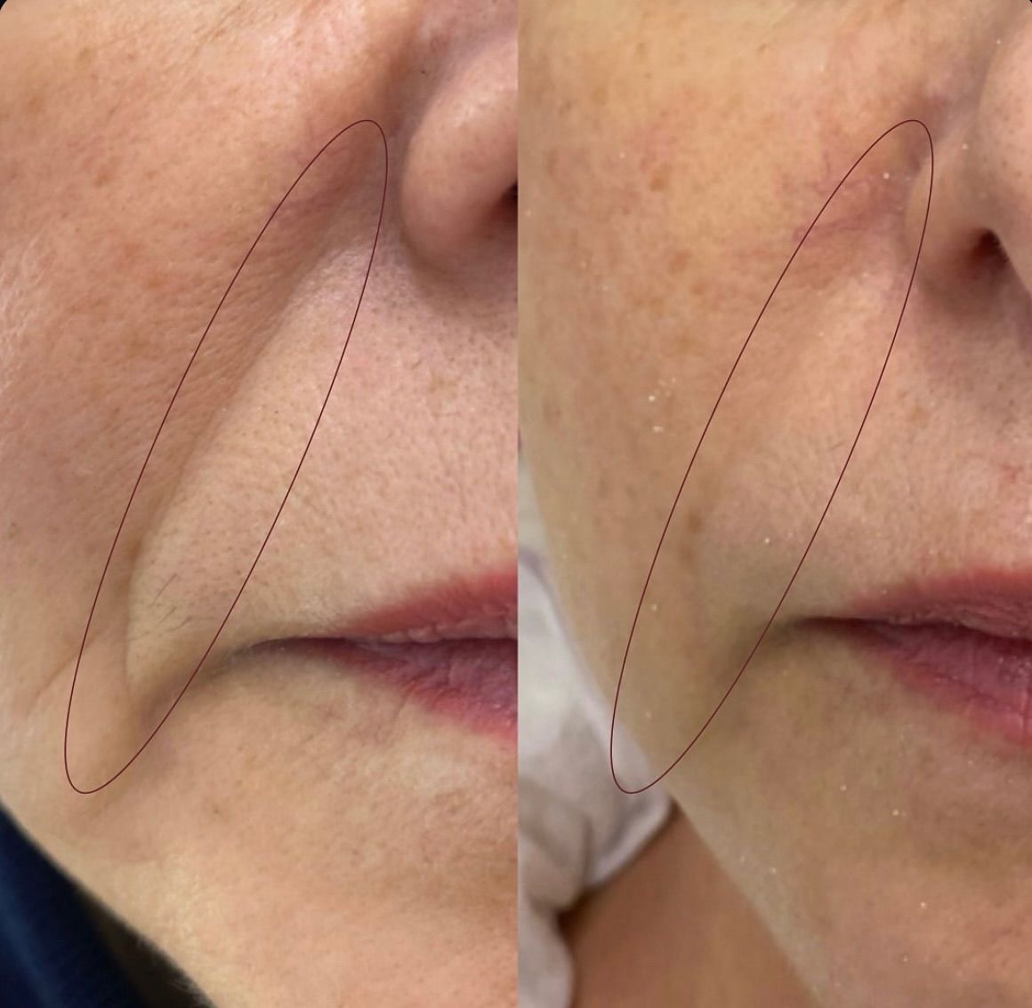 Șanț nazo-labial corectat acid hialuronic – Juvena